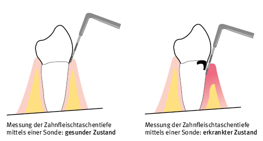 Parodontalbehandlung